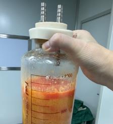 日喀则水动力吸脂手术要做多久？